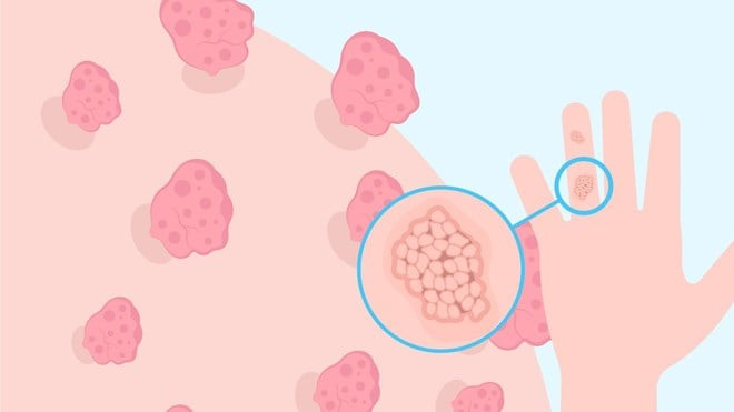 Một nốt nhỏ có thể thành ung thư, đừng chủ quan với sùi mào gà