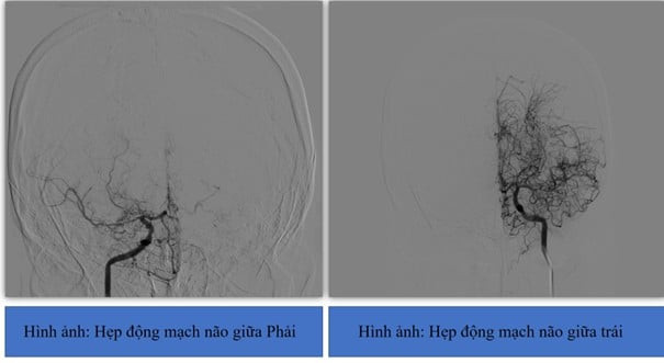 Đau đầu, khó nói, người phụ nữ bị nhồi máu não do căn bệnh hiếm gặp