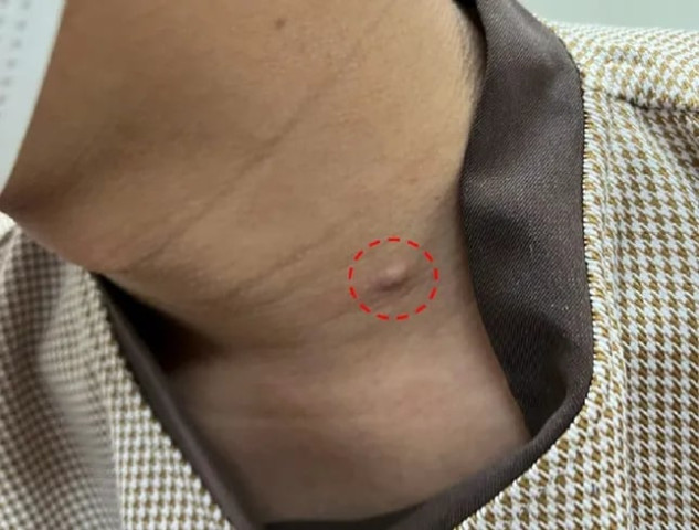 Mụn lâu lành biến thành ung thư da