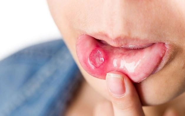 5 mẹo tự nhiên giúp làm dịu vết loét miệng