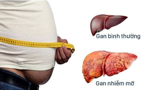 Những dấu hiệu cảnh báo sớm gan nhiễm mỡ