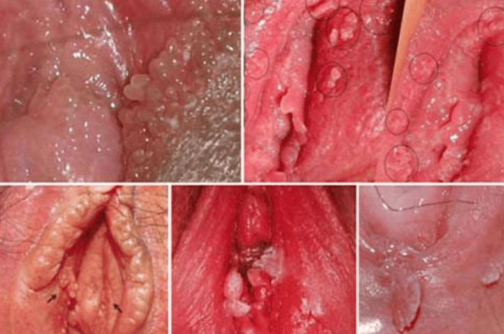 Những điều cần biết để tránh sùi mào gà ở nữ giới