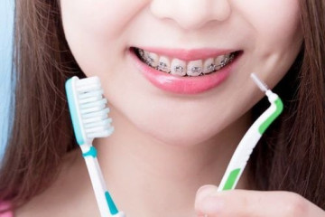 Những điều cần biết khi niềng răng
