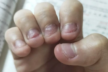Cắn móng tay có hại thế nào?