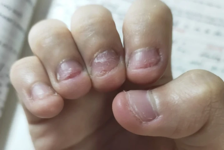 Cắn móng tay có hại thế nào?
