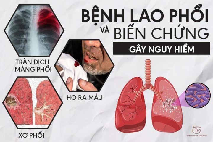 Gia Lai phấn đấu giảm tỷ lệ tử vong do bệnh lao dưới 1/100.000 người dân