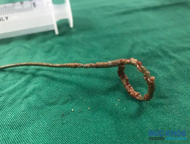 Quên tái khám sau phẫu thuật, bệnh nhân mang  ống sonde JJ niệu quản trong cơ thể suốt hơn 22 năm