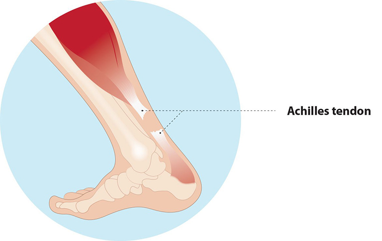 Dut Gan Achilles 1