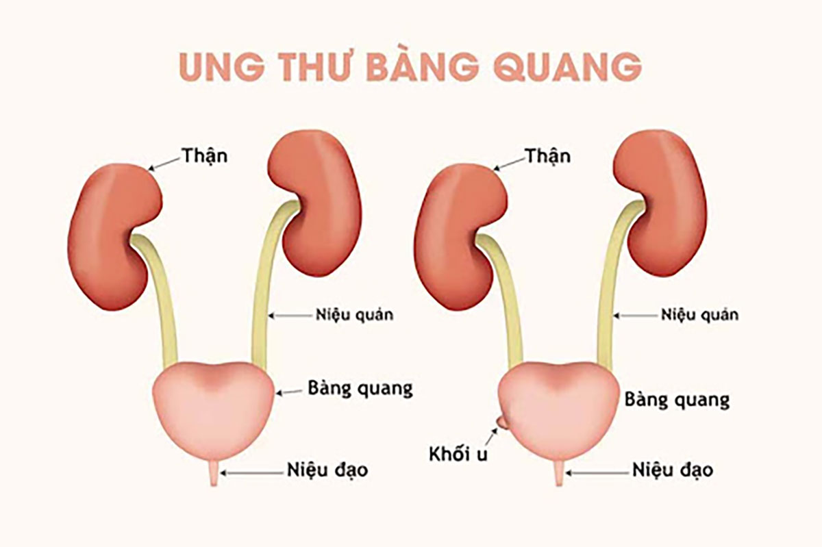 Các Phương Pháp điều Trị Ung Thư Bàng Quang