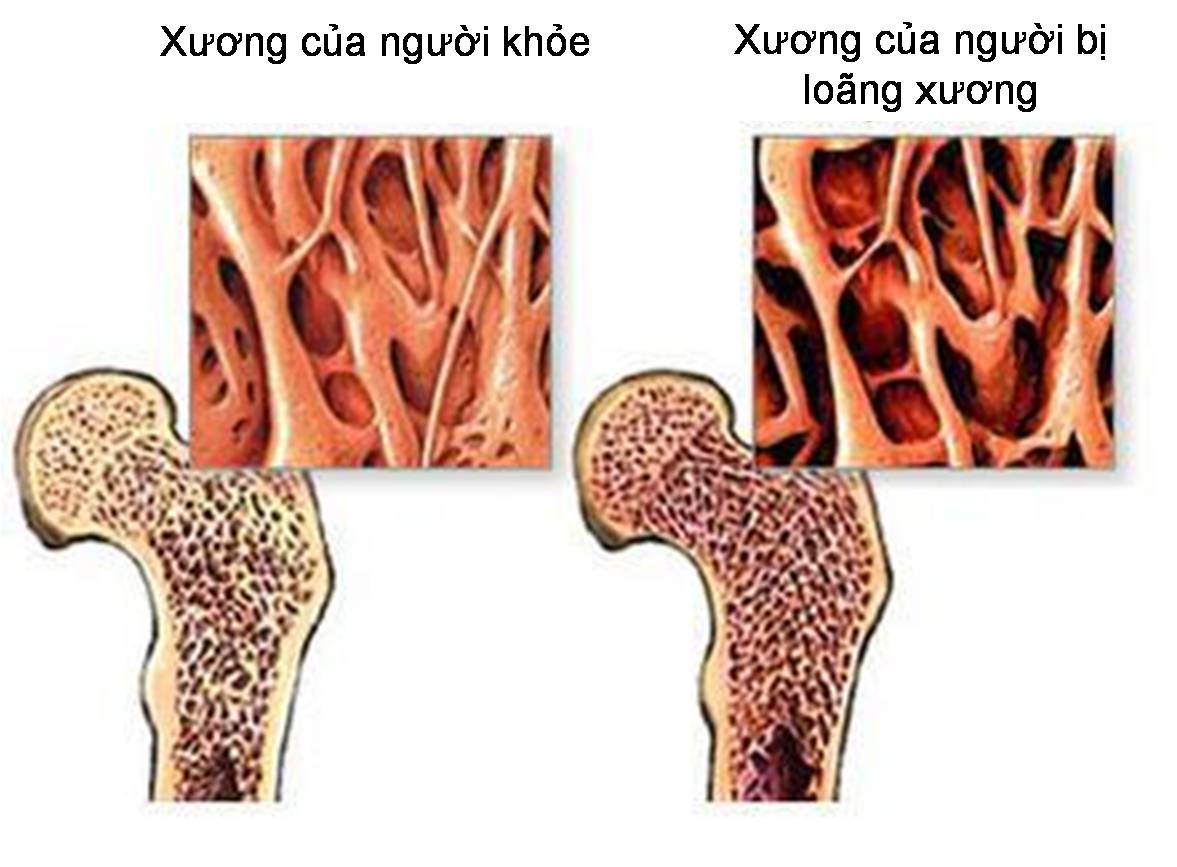 Loang Xuong5