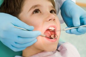 Sâu Răng ở Trẻ Em