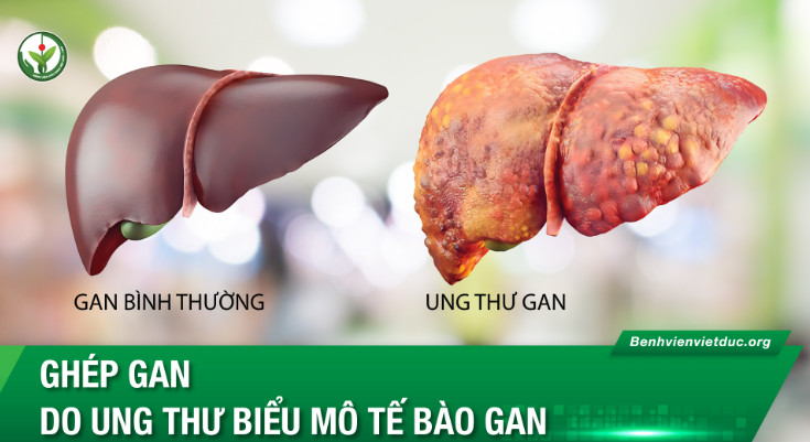 Ghép Gan Do Ung Thư Biểu Mô Tế Bào Gan