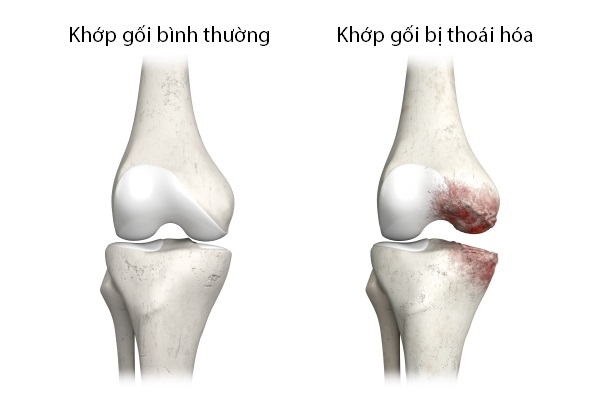 Triệu Chứng Thoái Hóa Khớp Gối