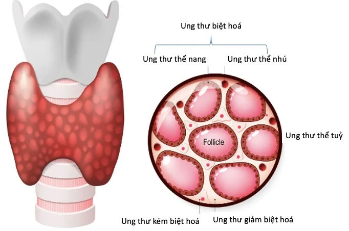 Di Căn Hạch Ung Thư Giáp Thể Nhú